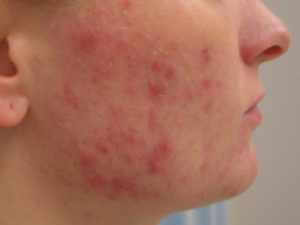 Accutane