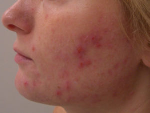 Accutane