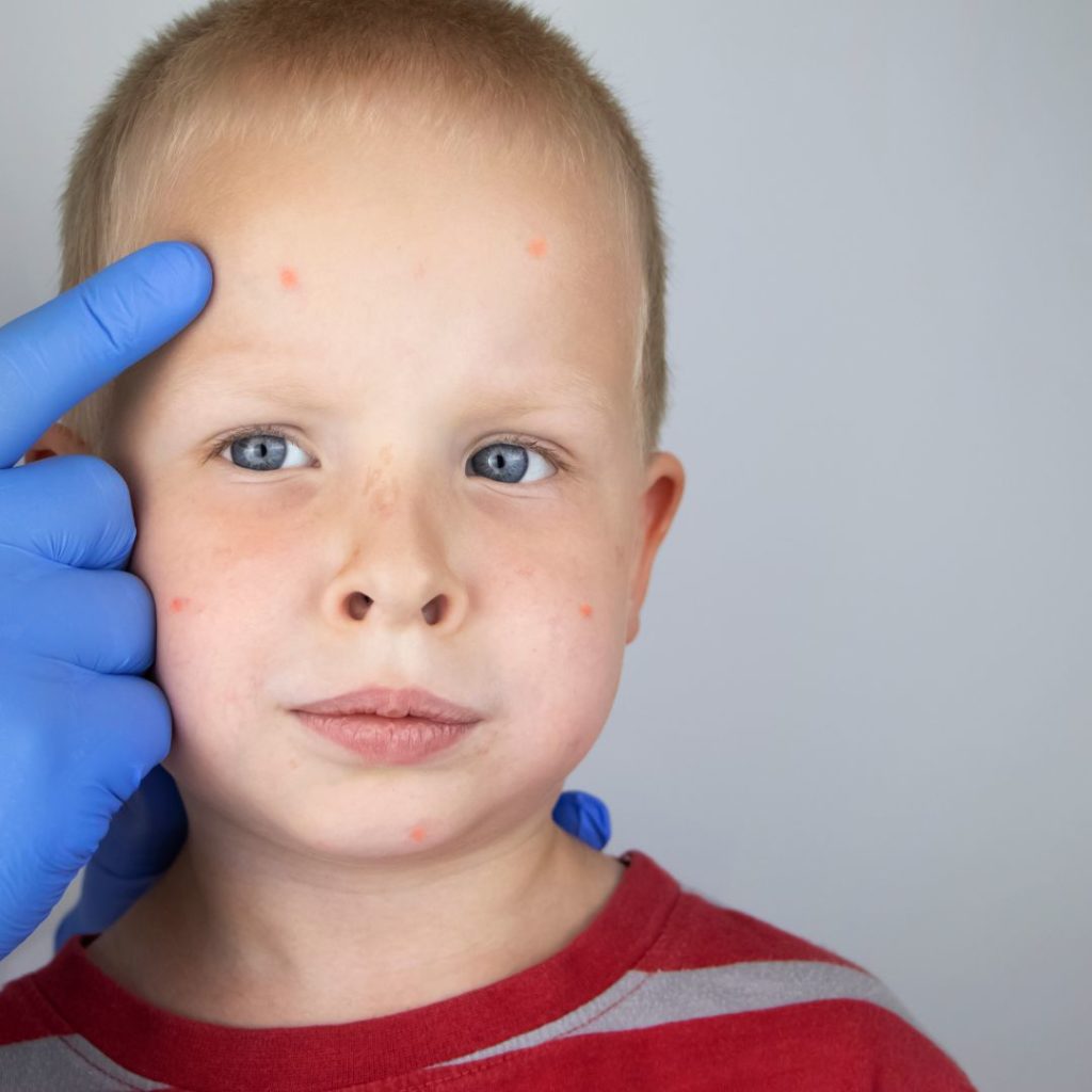 Read more about the article Pediatric Dermatology: 10 Common Skin Conditions in Children