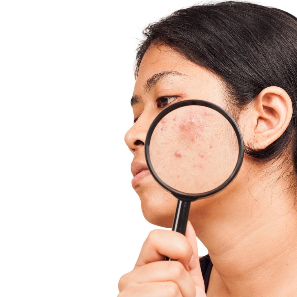 Read more about the article Acne Awareness Month: Get the Facts About Acne!