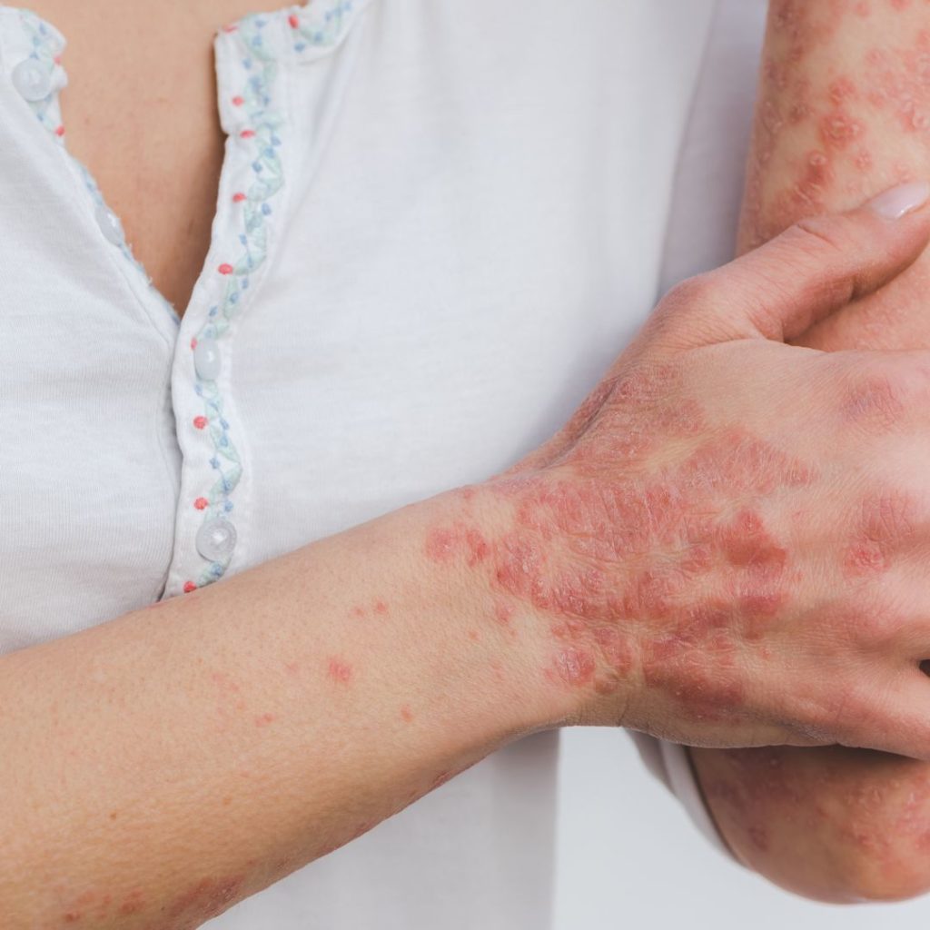 Read more about the article Psoriasis: Symptoms, Triggers, Types and Treatments