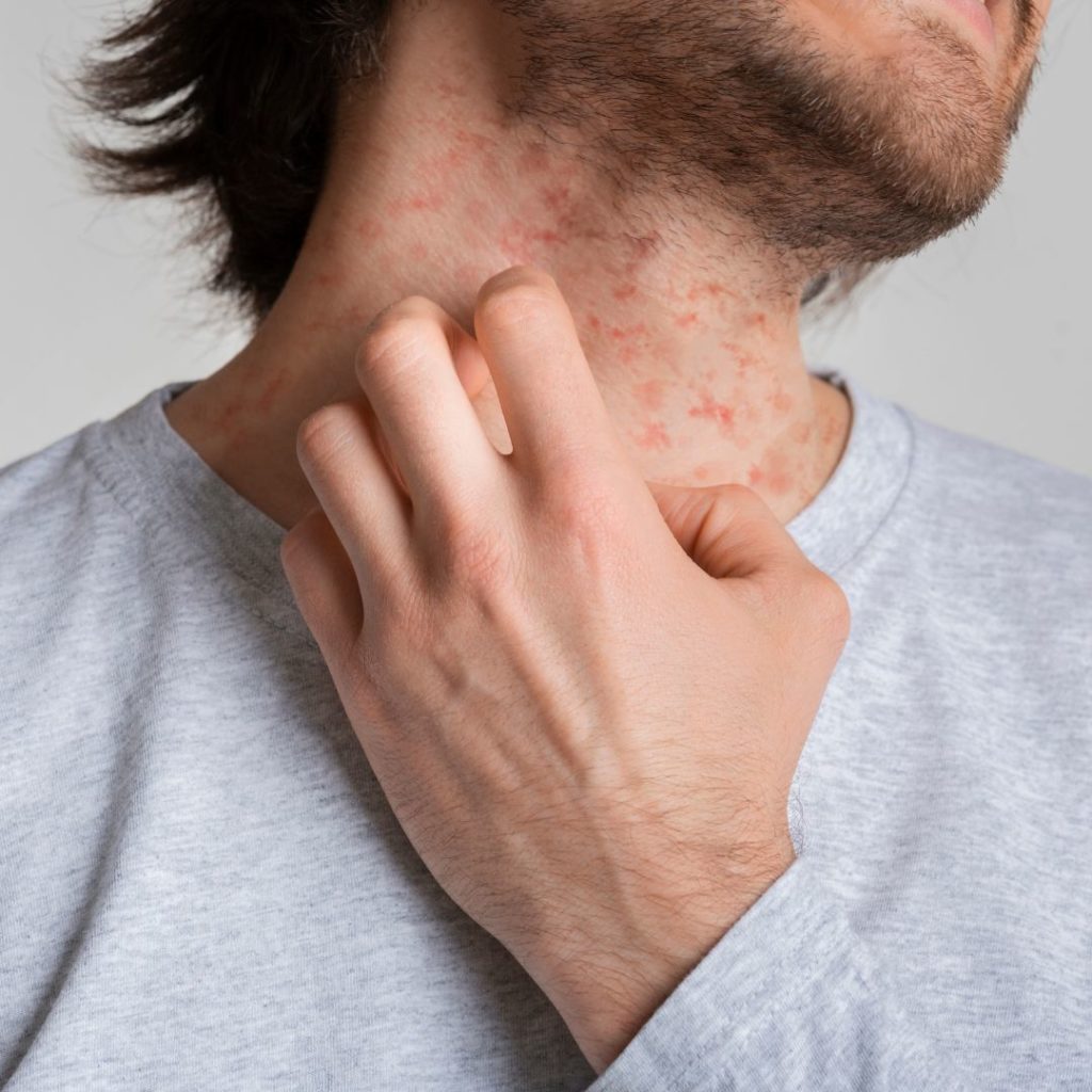 Read more about the article 5 Dermatologist-Approved Treatments for Eczema