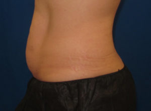 Coolsculpting PA