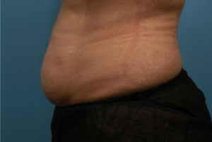 Coolsculpting PA