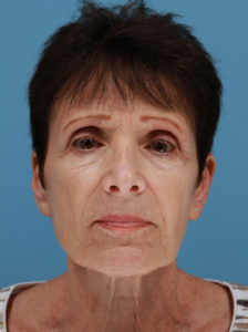 dermal fillers before image