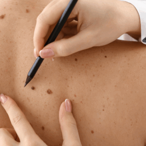 Melanoma
