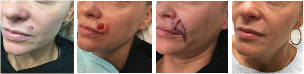 Mohs surgery before and after photos