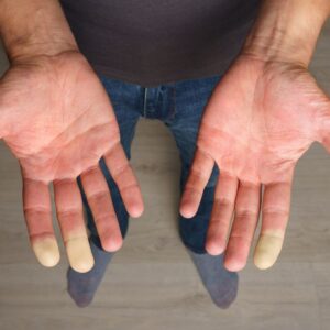 Raynaud's syndrome