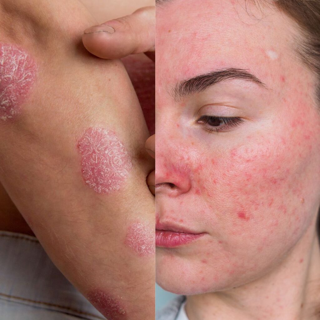 Rosacea and Eczema side by side