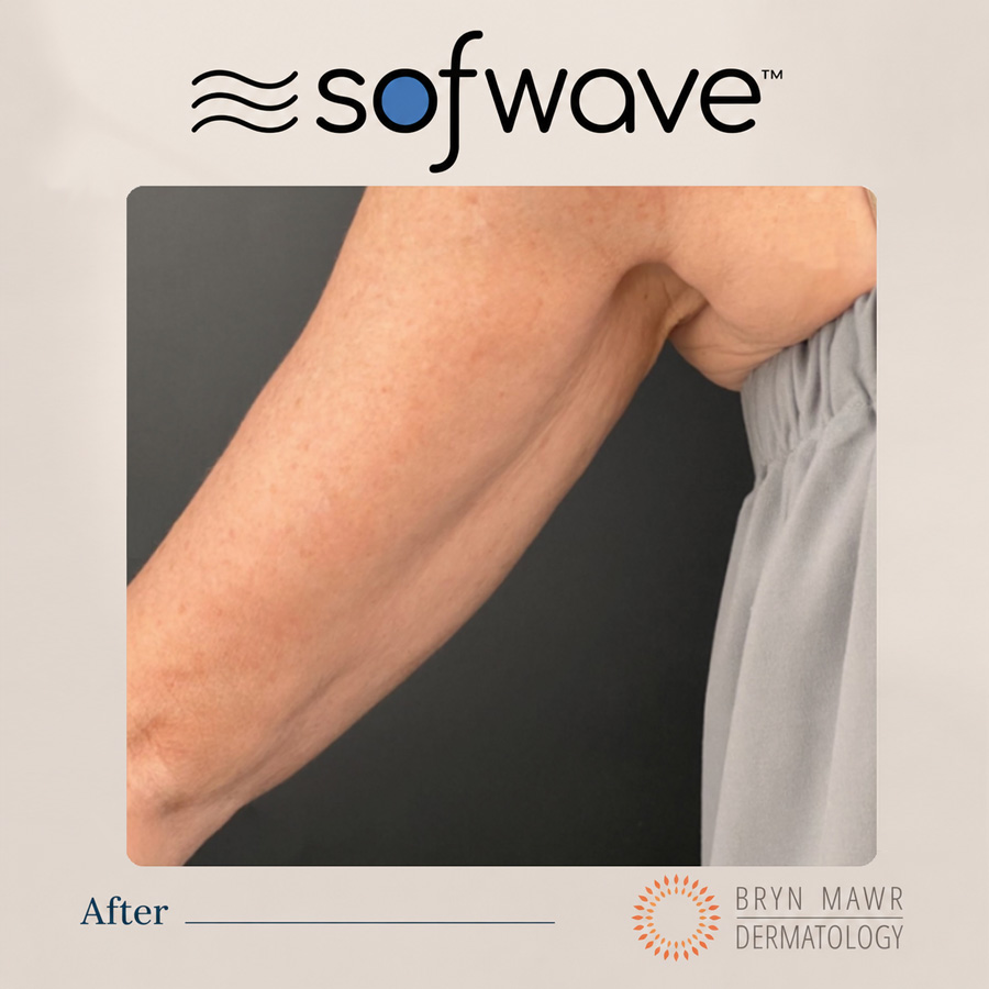 Sofwave - After image