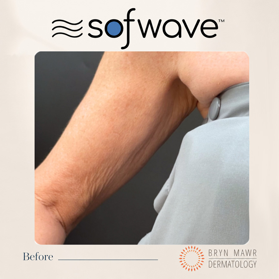 Sofwave - Before image