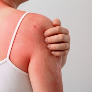 sunburn