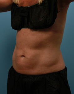 coolsculpting Consultation Collegeville PA