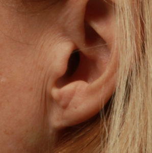 ear lobe repair