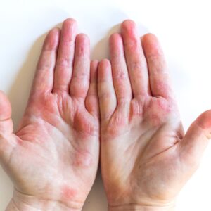 Eczema vs Rosacea