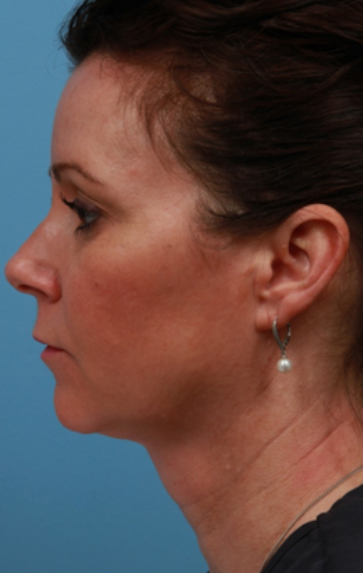 kybella after image