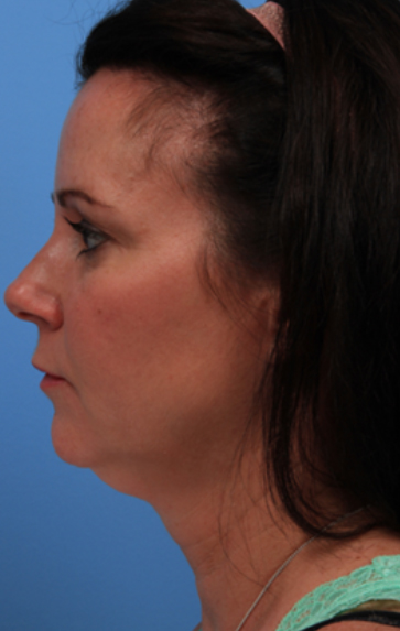 kybella before image