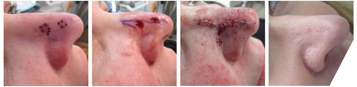 Mohs Surgery Before and After Photos