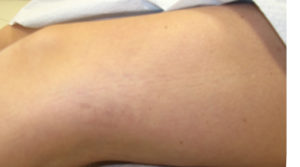 sclerotherapy